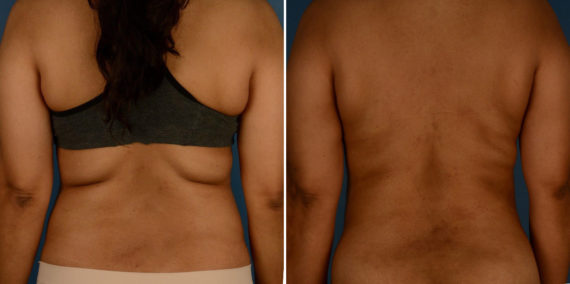 VASER® Liposuction Before and After Photos in Naples, FL, Patient 23241