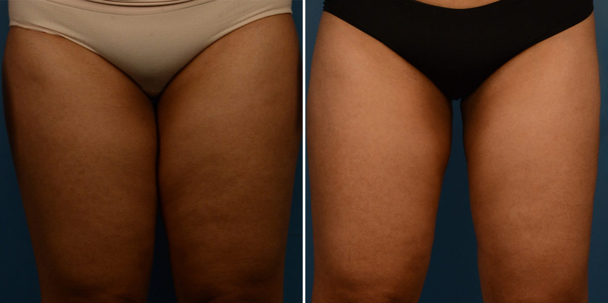 VASER® Liposuction Before and After Photos in Naples, FL, Patient 23241