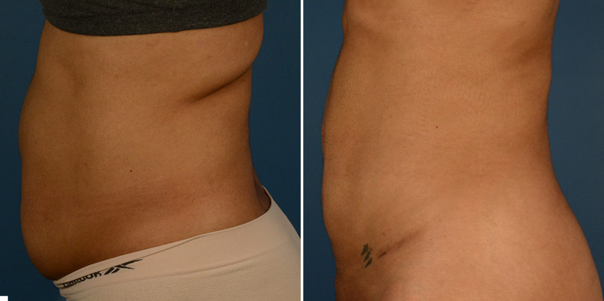 VASER® Liposuction Before and After Photos in Naples, FL, Patient 23241