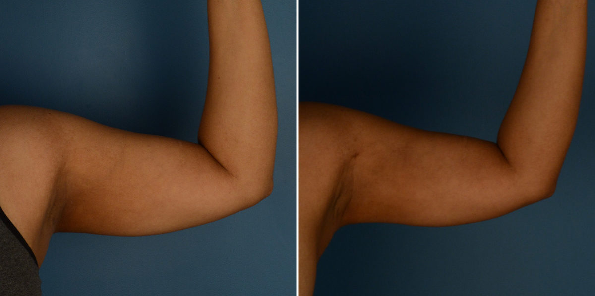VASER® Liposuction Before and After Photos in Naples, FL, Patient 23241