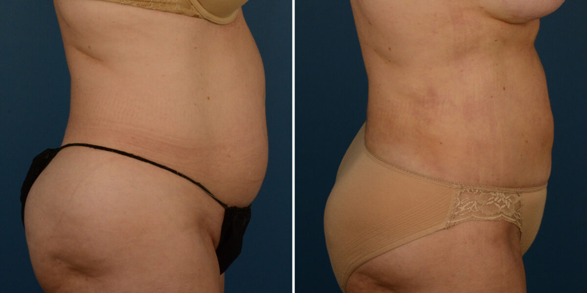 VASER® Liposuction Before and After Photos in Naples, FL, Patient 23274