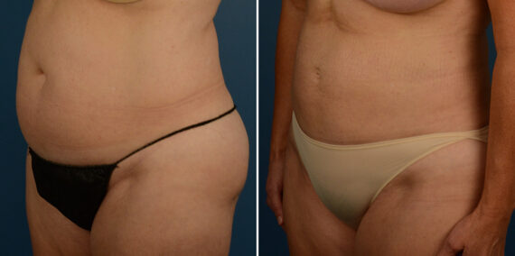 VASER® Liposuction Before and After Photos in Naples, FL, Patient 23274