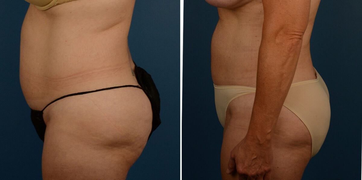 VASER® Liposuction Before and After Photos in Naples, FL, Patient 23274