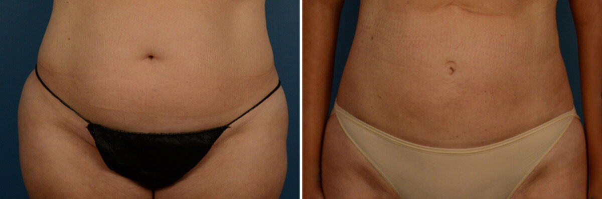 VASER® Liposuction Before and After Photos in Naples, FL, Patient 23274