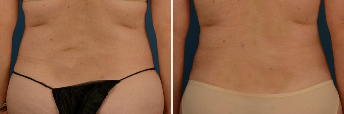 VASER® Liposuction Before and After Photos in Naples, FL, Patient 23274