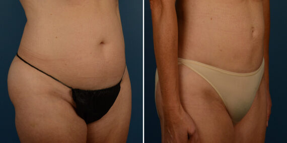 VASER® Liposuction Before and After Photos in Naples, FL, Patient 23274