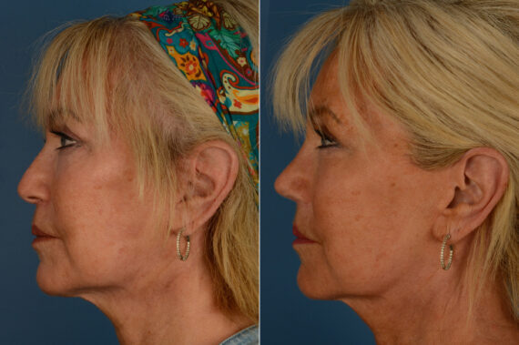 Rhinoplasty Before and After Photos in Naples, FL, Patient 20108