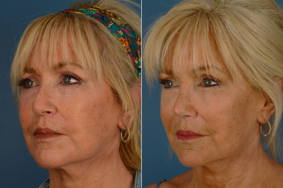 Rhinoplasty Before and After Photos in Naples, FL, Patient 20108