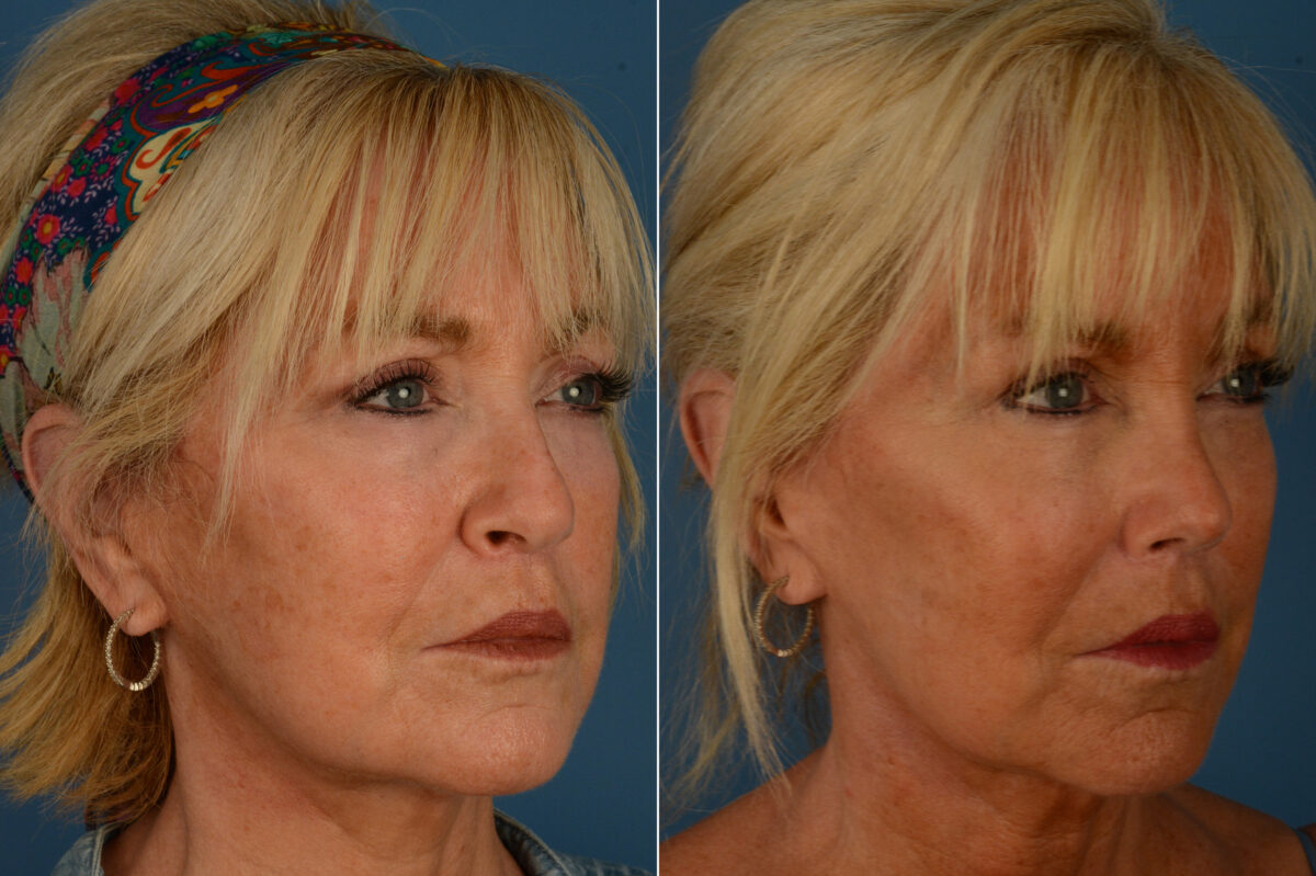 Rhinoplasty Before and After Photos in Naples, FL, Patient 20108