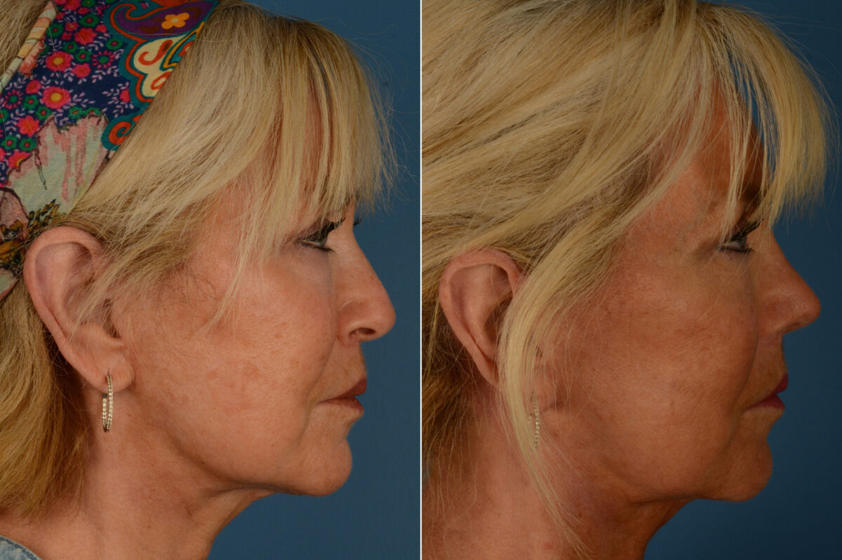 Rhinoplasty Before and After Photos in Naples, FL, Patient 20108