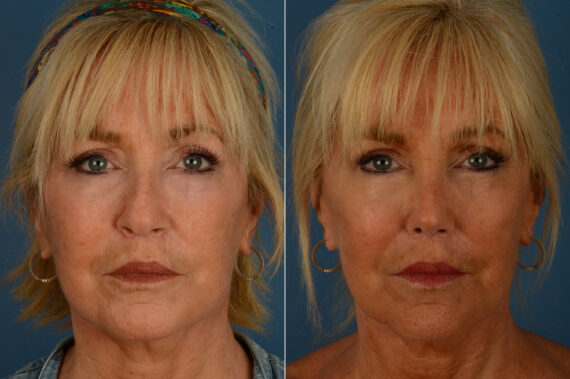 Rhinoplasty Before and After Photos in Naples, FL, Patient 20108