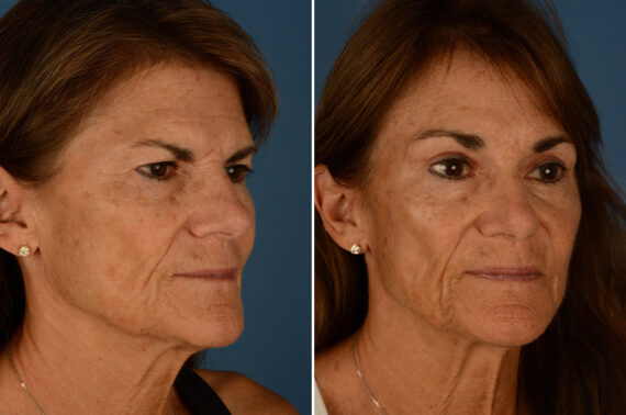 Eyebrow & Forehead Before and After Photos in Naples, FL, Patient 23323