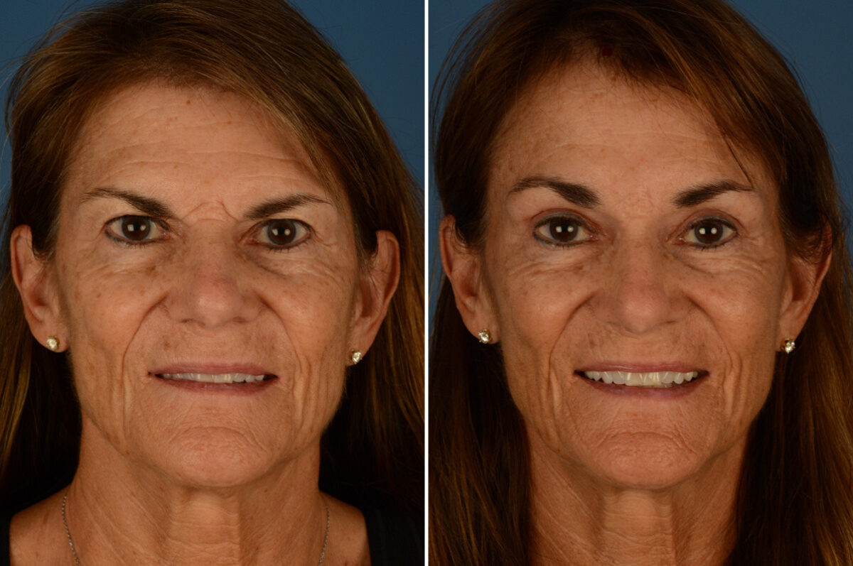 Eyebrow & Forehead Before and After Photos in Naples, FL, Patient 23323