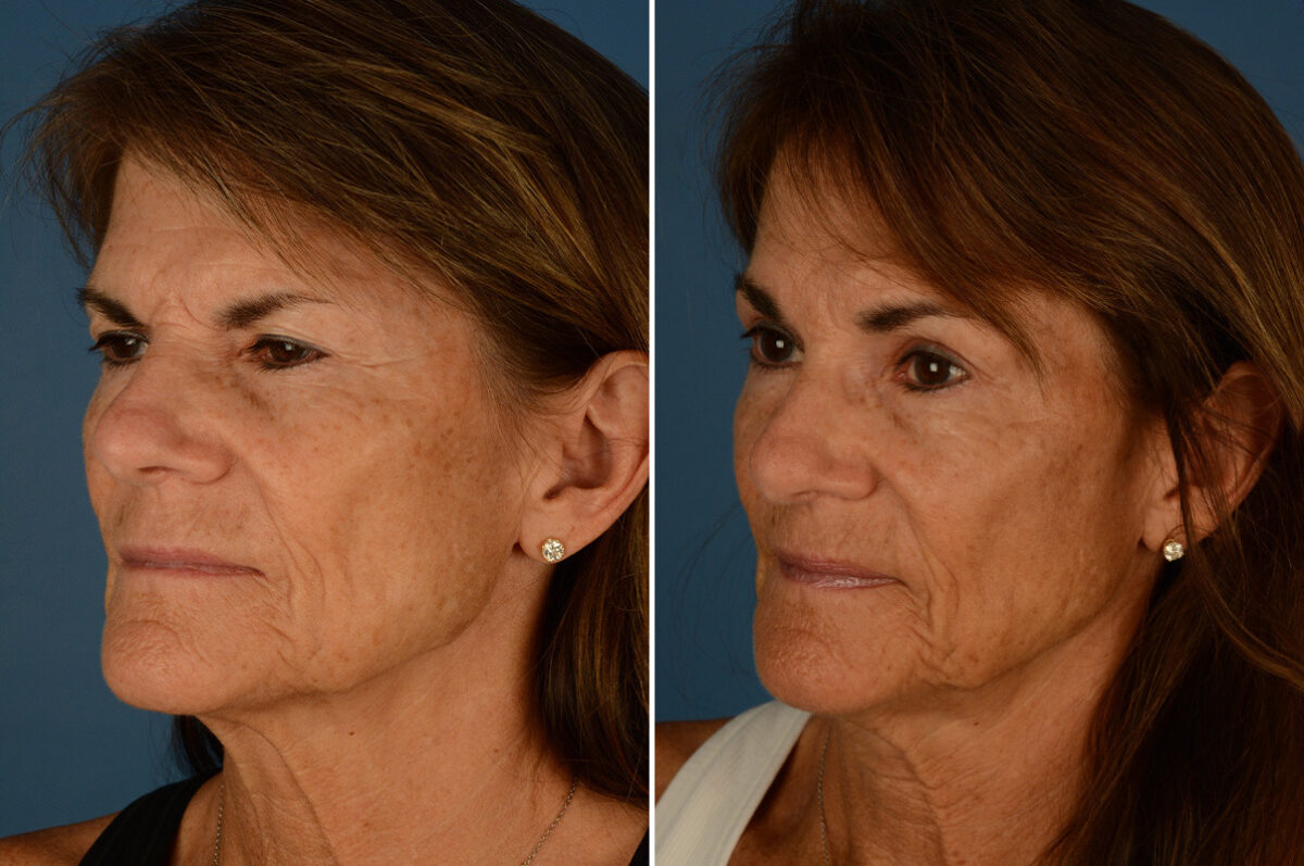 Eyebrow & Forehead Before and After Photos in Naples, FL, Patient 23323