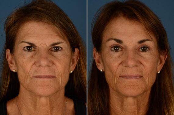 Eyebrow & Forehead Before and After Photos in Naples, FL, Patient 23323