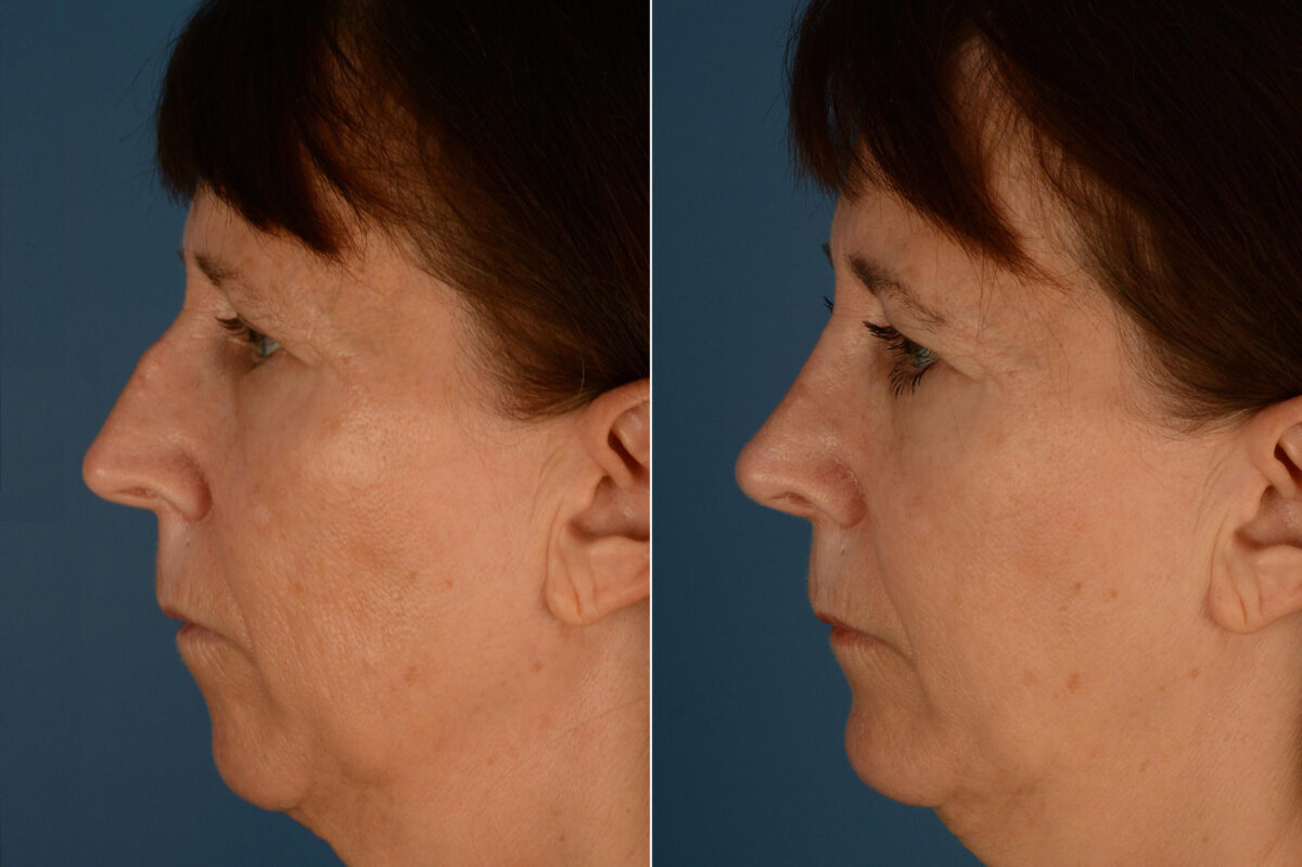 Rhinoplasty Before and After Photos in Naples, FL, Patient 23375