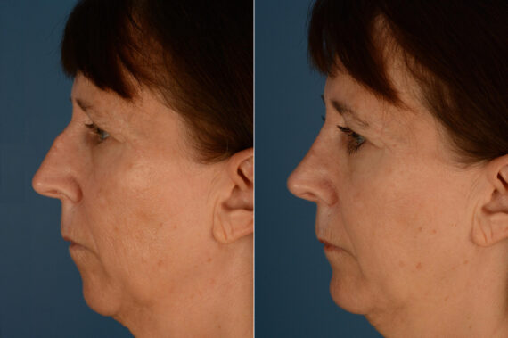 Rhinoplasty Before and After Photos in Naples, FL, Patient 23375