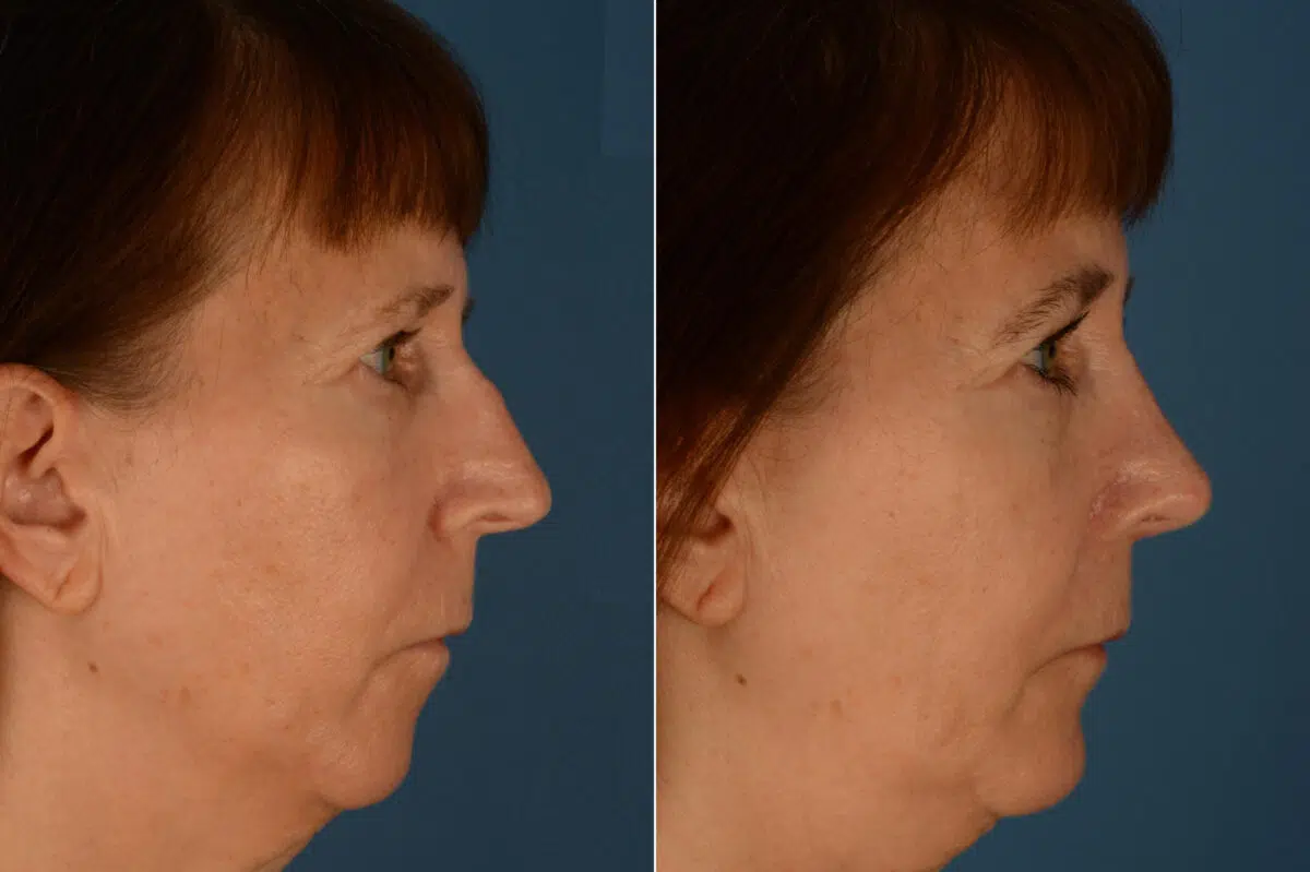 Rhinoplasty Before and After Photos in Naples, FL, Patient 23375