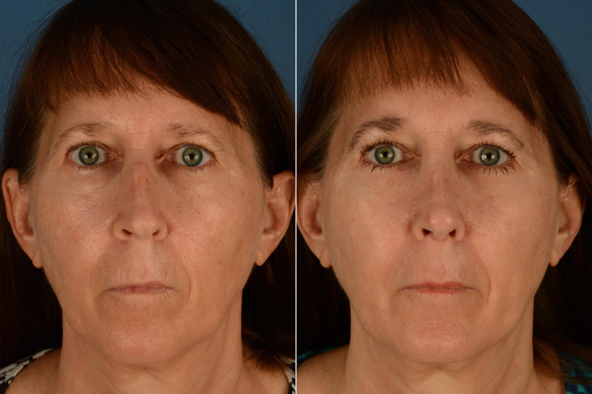 Rhinoplasty Before and After Photos in Naples, FL, Patient 23375