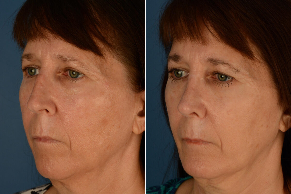 Rhinoplasty Before and After Photos in Naples, FL, Patient 23375