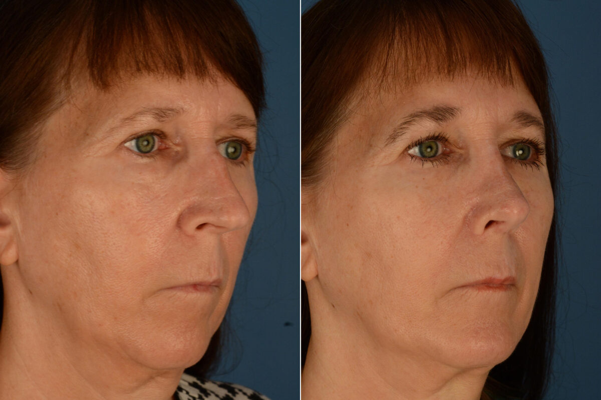 Rhinoplasty Before and After Photos in Naples, FL, Patient 23375