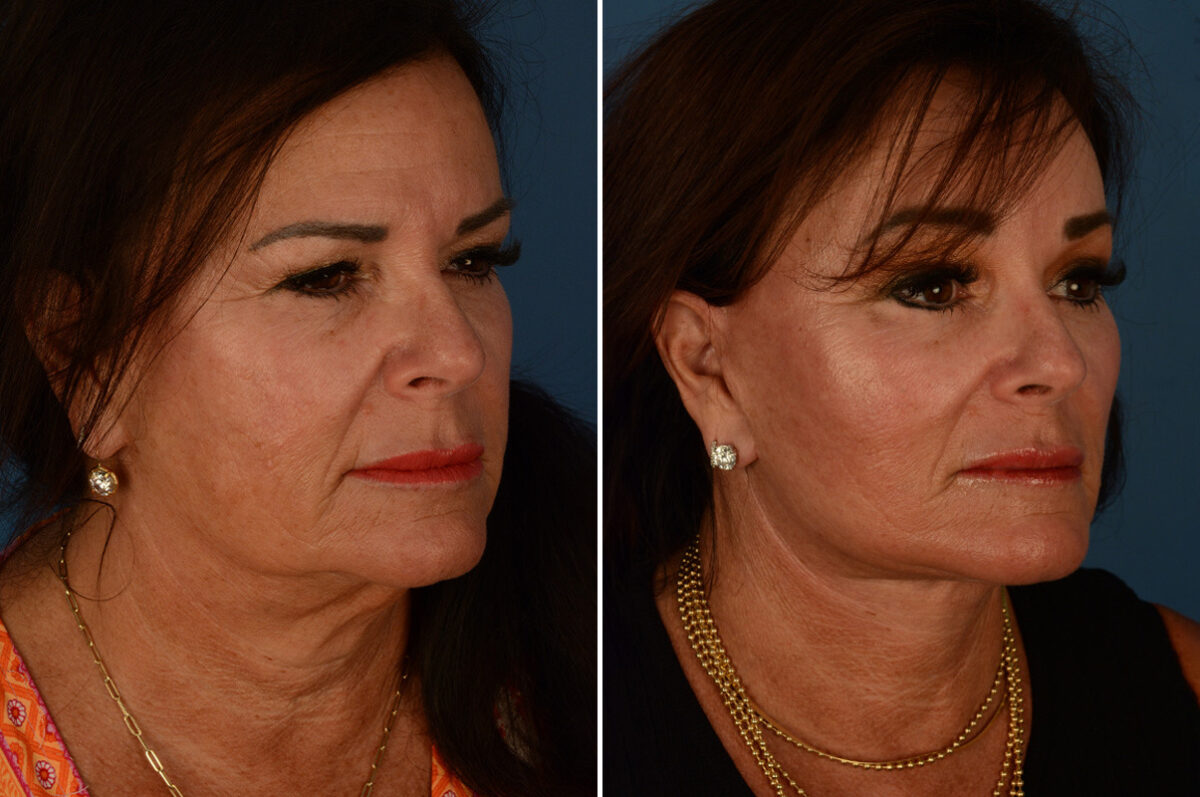Endoscopic Facelift Before and After Photos in Naples, FL, Patient 23383