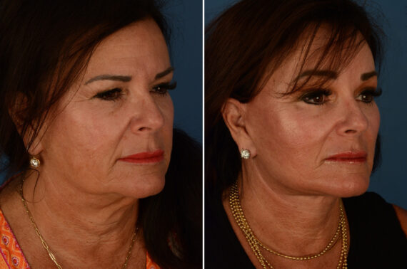 Endoscopic Facelift Before and After Photos in Naples, FL, Patient 23383