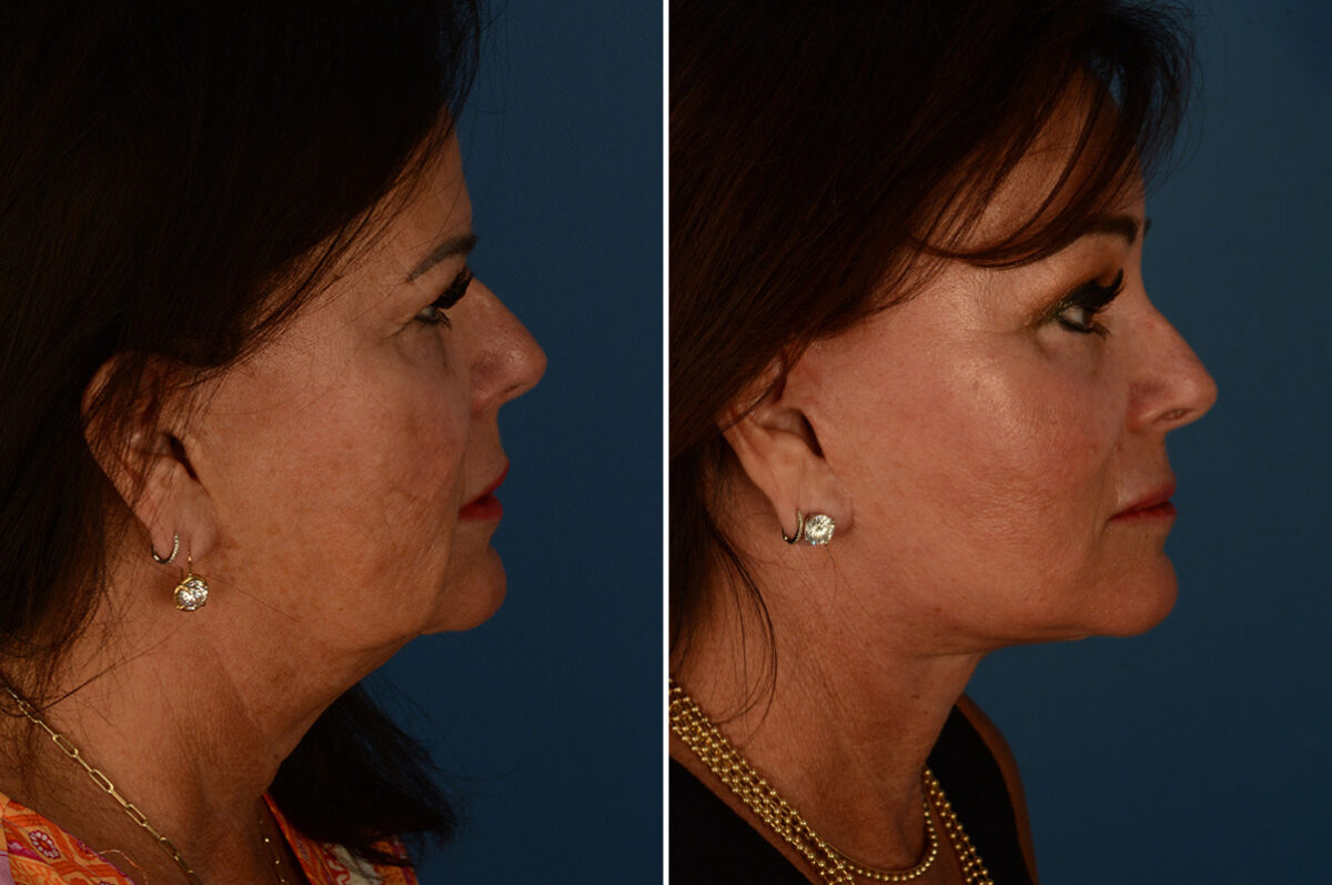 Endoscopic Facelift Before and After Photos in Naples, FL, Patient 23383