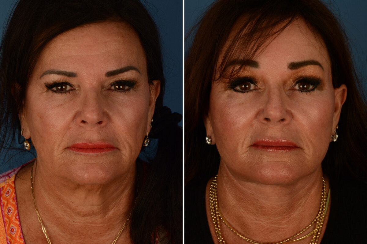 Endoscopic Facelift Before and After Photos in Naples, FL, Patient 23383