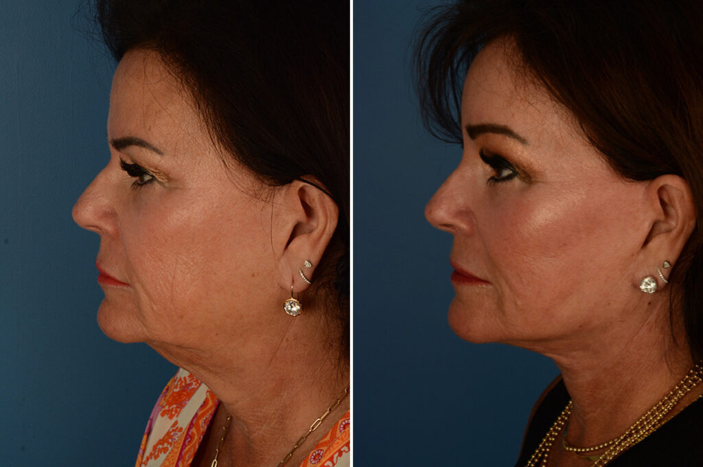 Endoscopic Facelift Photos Naples, FL Patient 23383