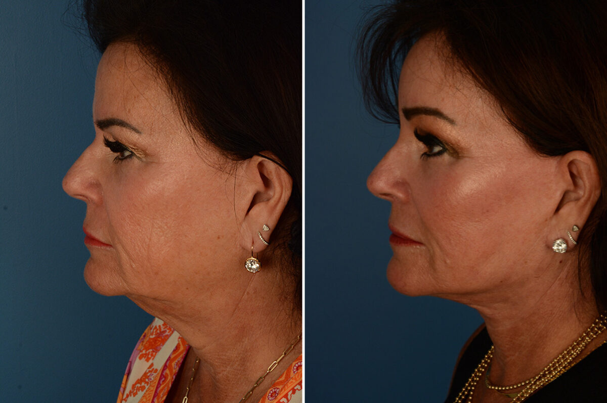 Endoscopic Facelift Before and After Photos in Naples, FL, Patient 23383