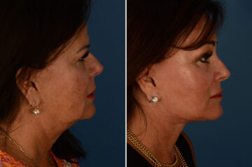 Endoscopic Facelift Before and After Photos in Naples, FL, Patient 23383