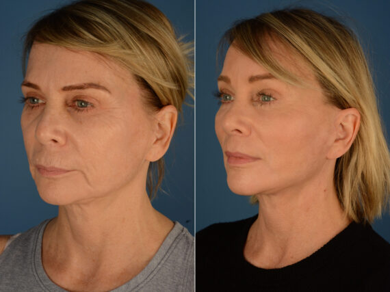 Endoscopic Facelift Before and After Photos in Naples, FL, Patient 23411
