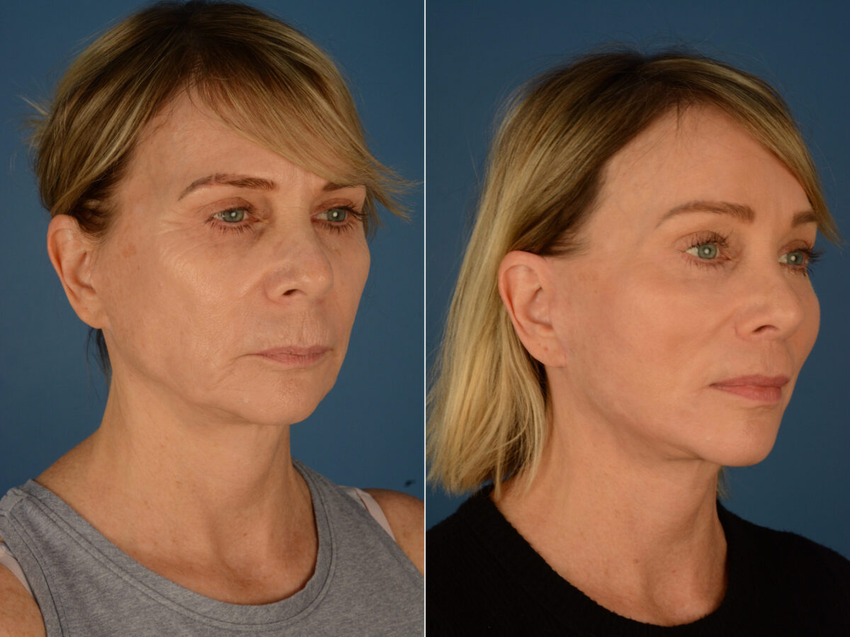 Endoscopic Facelift Before and After Photos in Naples, FL, Patient 23411