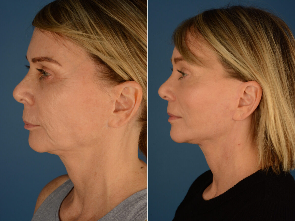 Endoscopic Facelift Before and After Photos in Naples, FL, Patient 23411