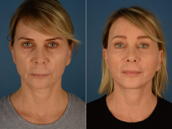 Endoscopic Facelift Before and After Photos in Naples, FL, Patient 23411
