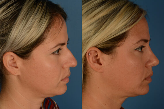 Rhinoplasty Before and After Photos in Naples, FL, Patient 19865