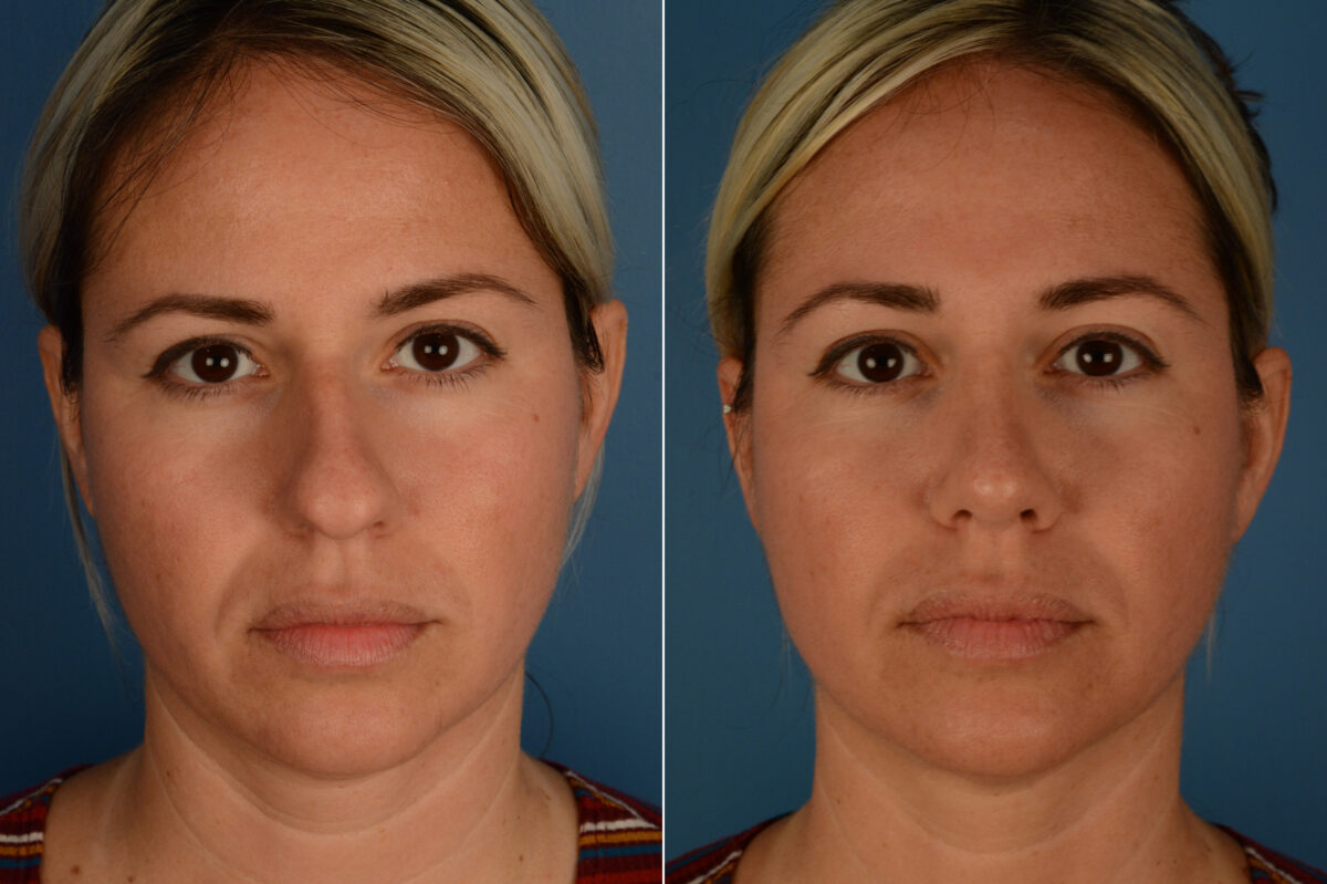 Rhinoplasty Before and After Photos in Naples, FL, Patient 19865