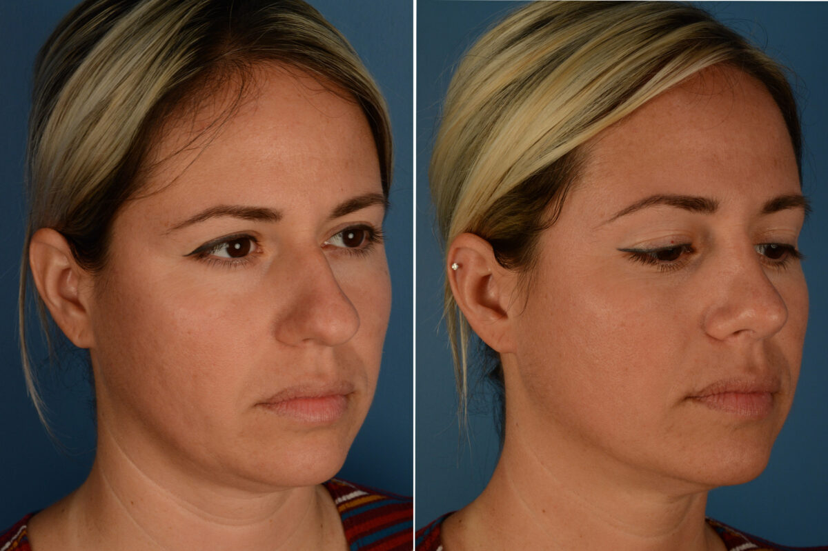 Rhinoplasty Before and After Photos in Naples, FL, Patient 19865