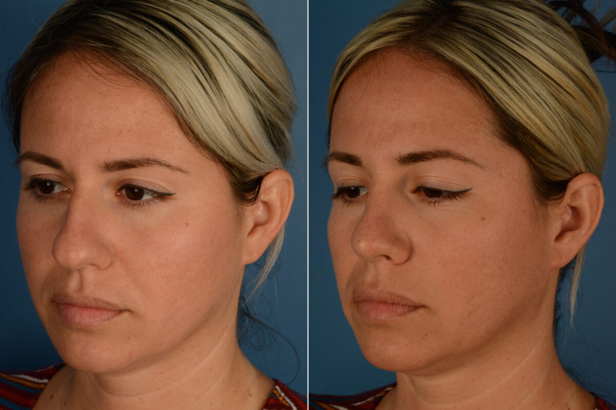 Rhinoplasty Before and After Photos in Naples, FL, Patient 19865