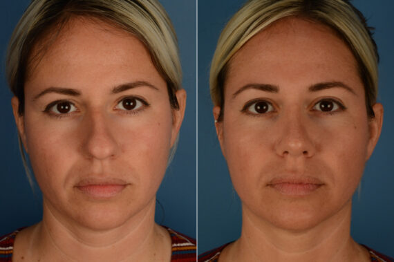 Rhinoplasty Before and After Photos in Naples, FL, Patient 19865