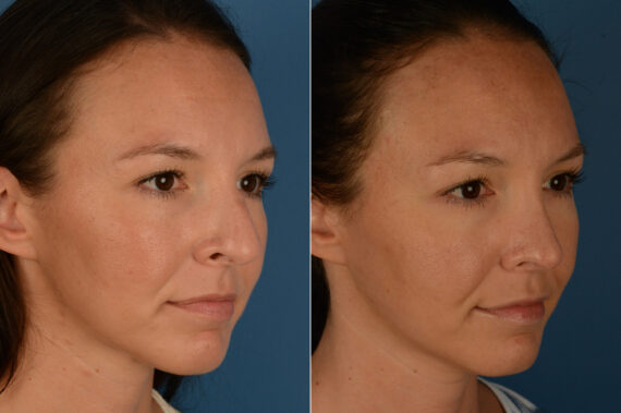 Rhinoplasty Before and After Photos in Naples, FL, Patient 19965