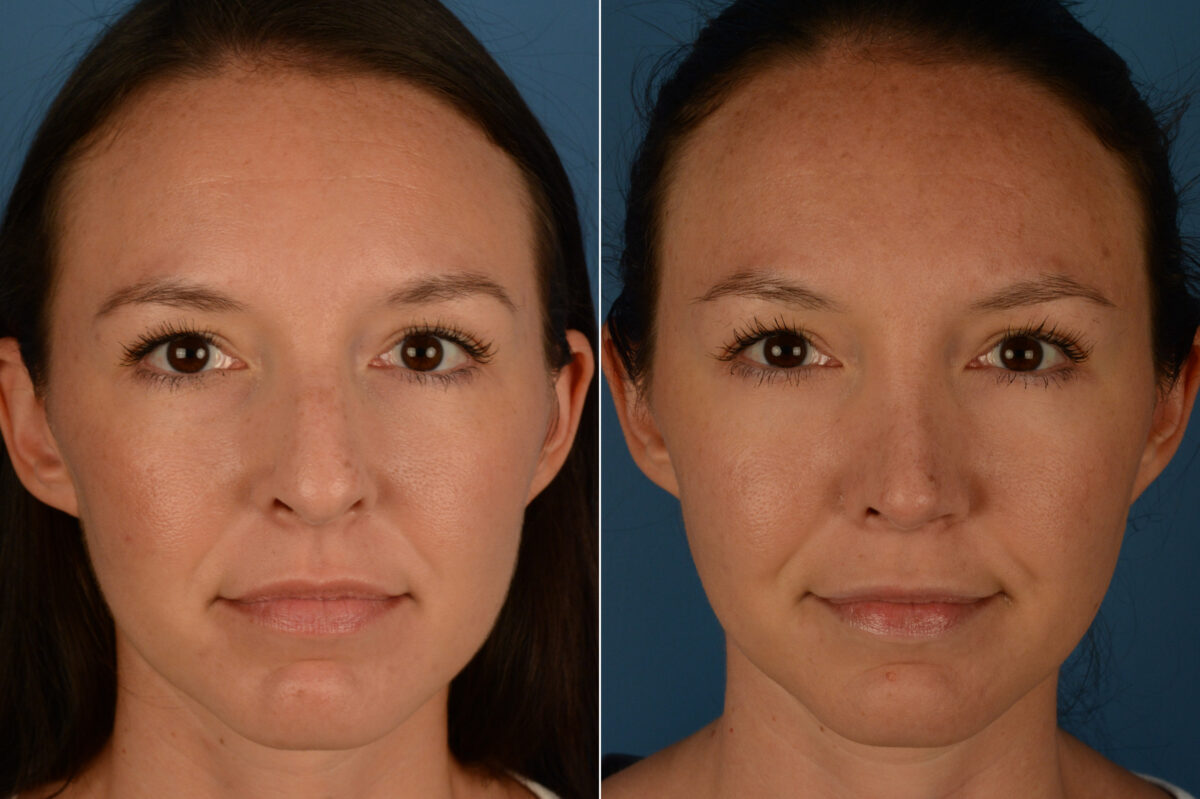 Rhinoplasty Before and After Photos in Naples, FL, Patient 19965