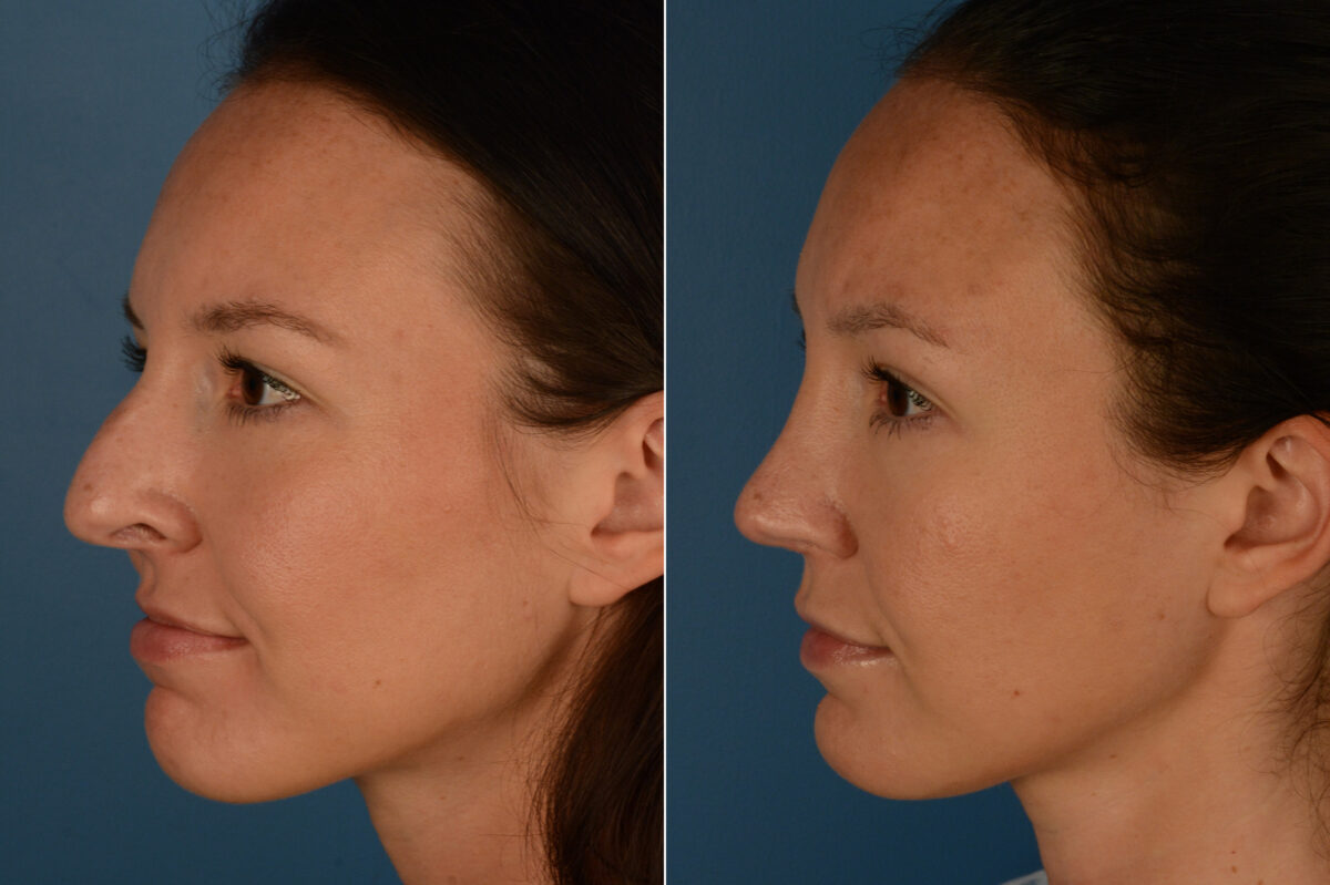 Rhinoplasty Before and After Photos in Naples, FL, Patient 19965