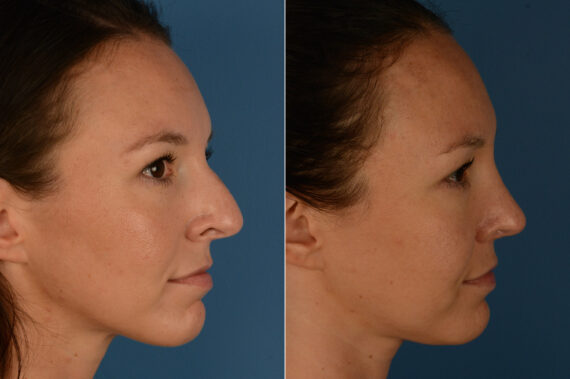 Rhinoplasty Before and After Photos in Naples, FL, Patient 19965