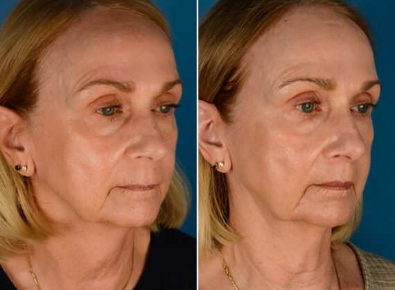 Lip Lift Before and After Photos in Naples, FL, Patient 23462