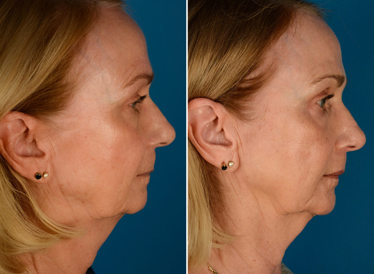 CO2 Laserwash Before and After Photos in Naples, FL, Patient 23462