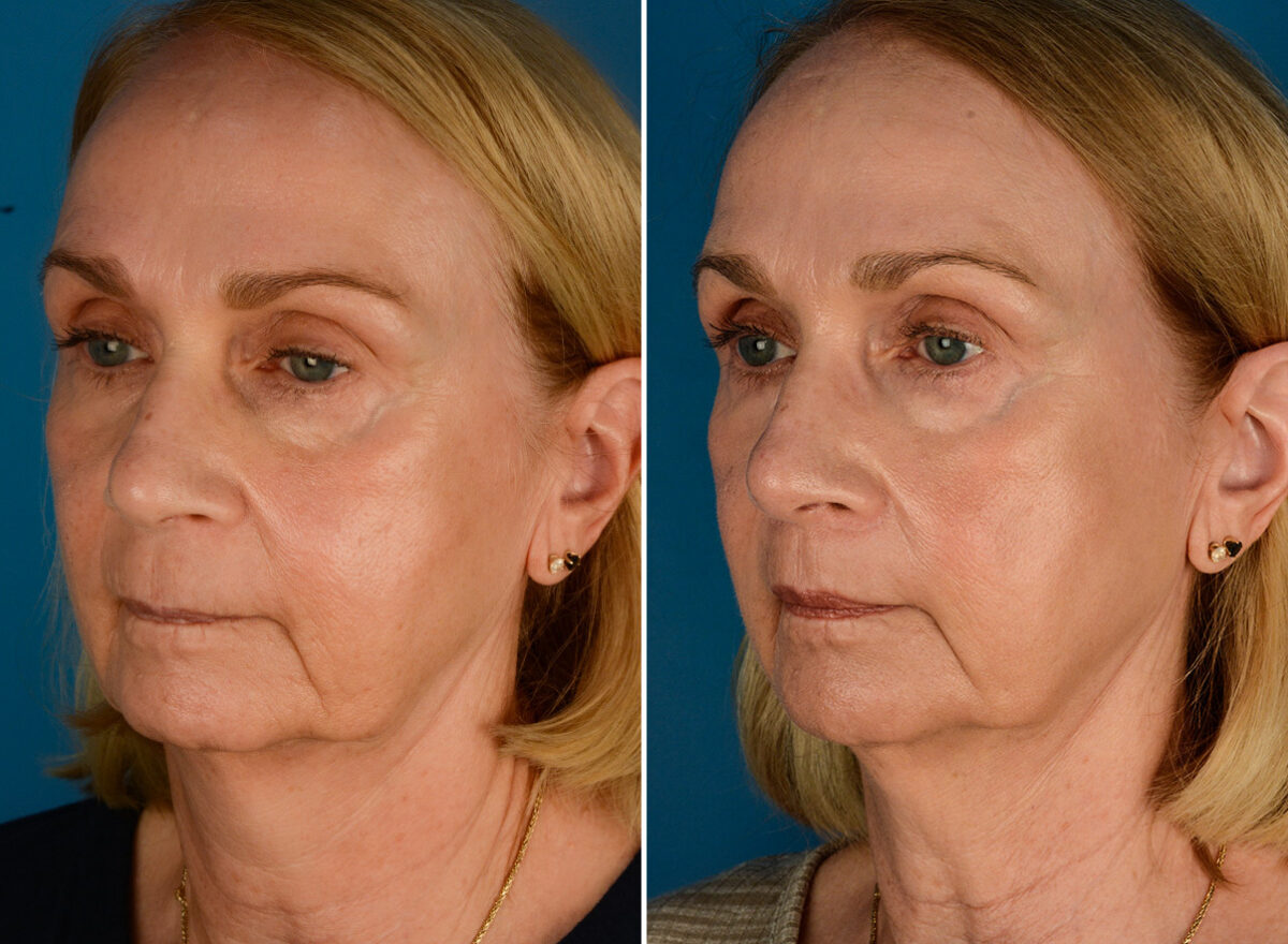 CO2 Laserwash Before and After Photos in Naples, FL, Patient 23462
