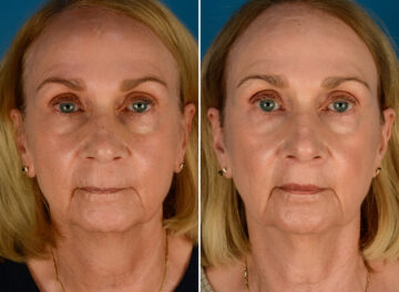 Lip Lift Before and After Photos in Naples, FL, Patient 23462