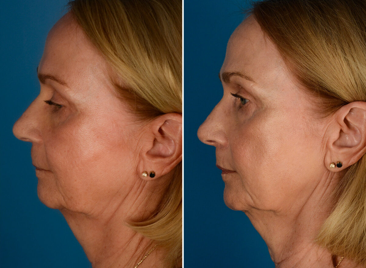 CO2 Laserwash Before and After Photos in Naples, FL, Patient 23462